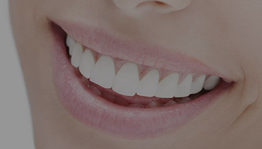 Teeth Whitening